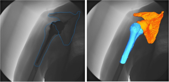 Registration of Implant (orange and blue) to fluoroscopic image 